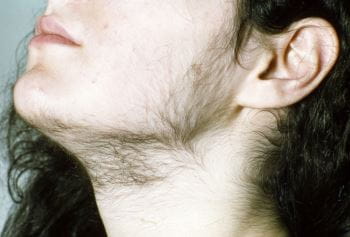 m1700060-excessive-facial-hair-in-a-woman-science-photo-library m1700060-excessive-facial-hair-in-a-woman-science-photo-library