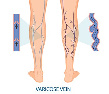 מתי יש להתערב בדליות? הבחירה הטובה ביותר למנוע עיכובים