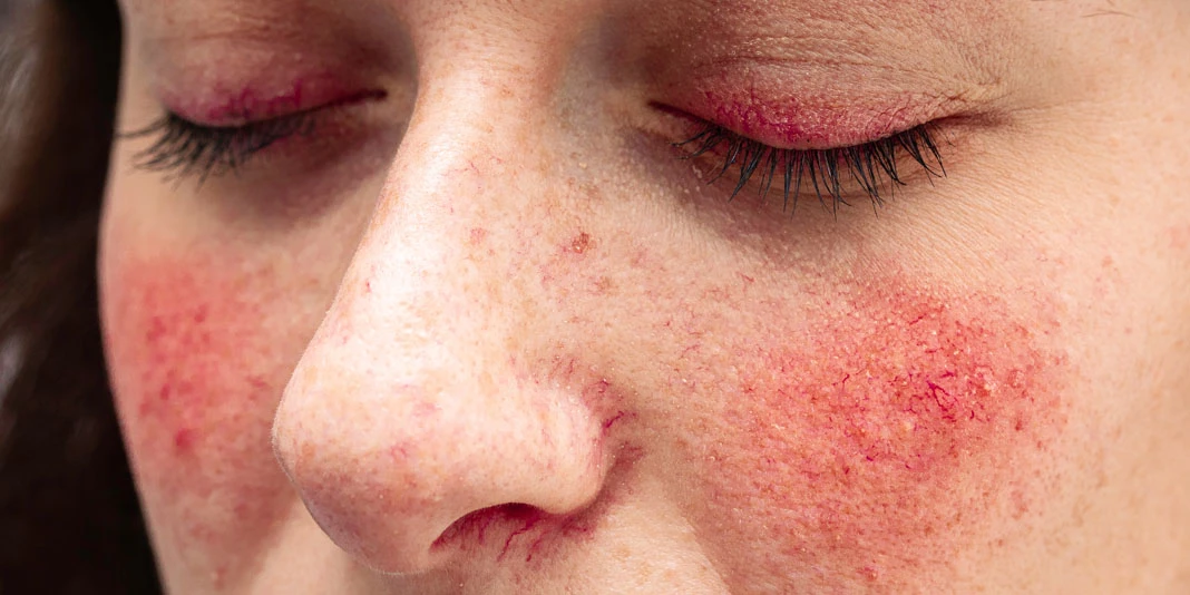 Redness of the skin Redness of the skin